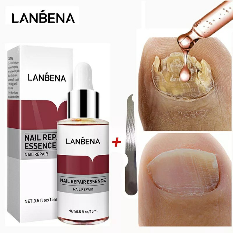 LANBENA” Anti Paronychia Nail Repair Relief Oil!!